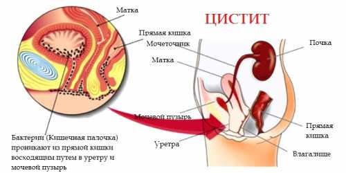 профилактика рака толстого кишечника: 5 рекомендаций